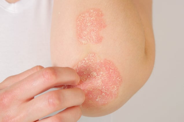 Psoriasis