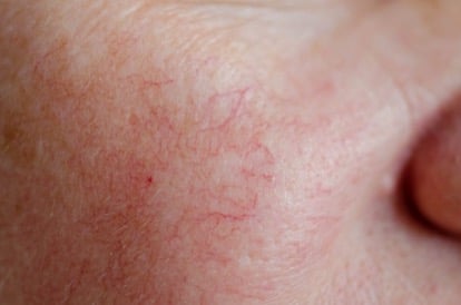 Rosacea (Couperose)